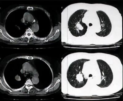 肺功能检查要怎么做，能查出哪些疾病？