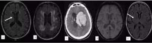 脑小血管病-张微微教授：脑小血管病的概念及病理分类