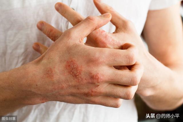 手湿疹和手癣，预防和治疗有哪些注意事项，本文一次性为你说清楚