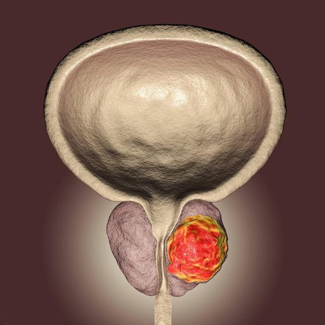 前列腺特异性抗原（PSA）-诊断前列腺癌的重要指标！
