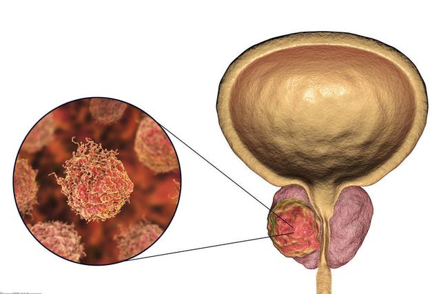 前列腺特异性抗原（PSA）-诊断前列腺癌的重要指标！