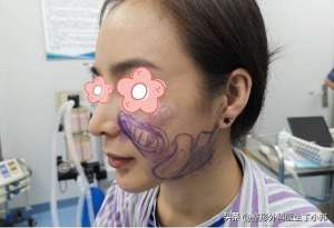 美女美容针(80后美女打了10年美容针，脸上凹凸不平，来修复平整)