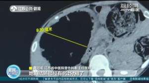 美女便秘吃药(不能乱吃药女子自行服药治便秘 不慎得了肠梗阻)