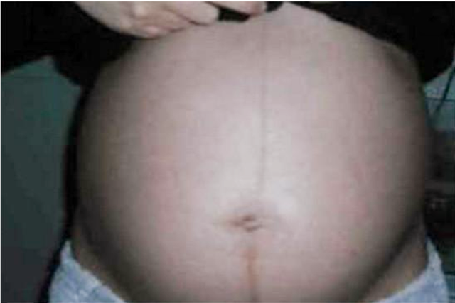 孕期这些部位黑到“怀疑人生”,孕妈别担心,这是娃发育好的表现