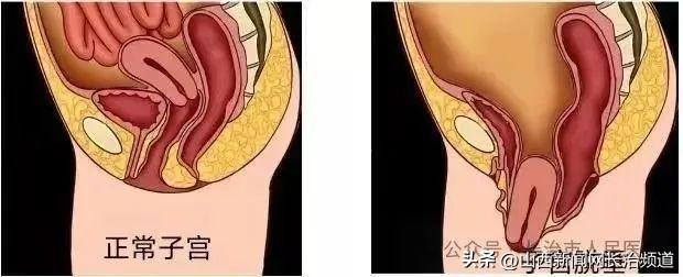 新突破!长治市人民医院妇科成功开展晋东南首例TVUS手术