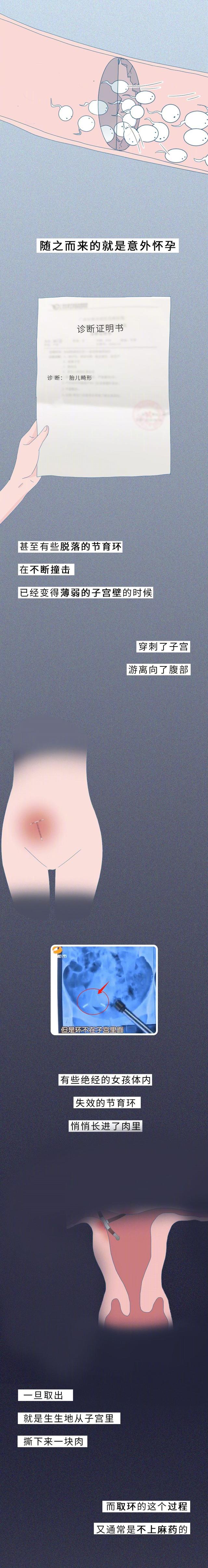 一张图告诉你“节育环”在女性体内的20年，没人能笑着看完