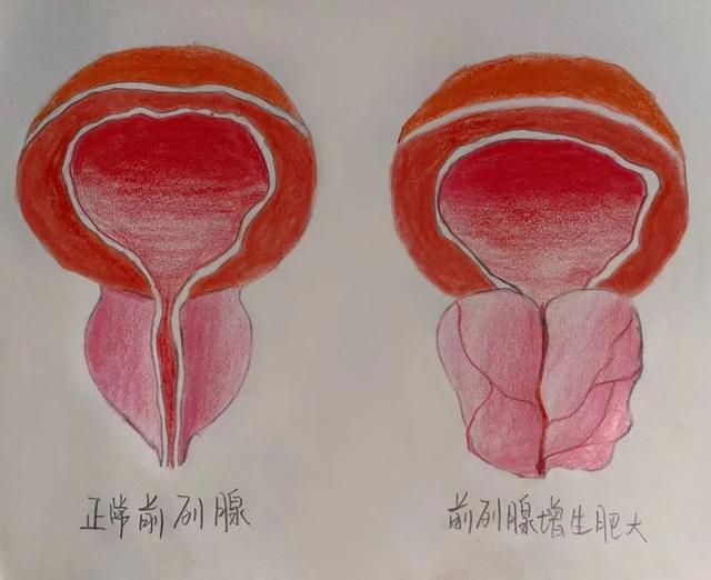 男性这个增生不容忽视~