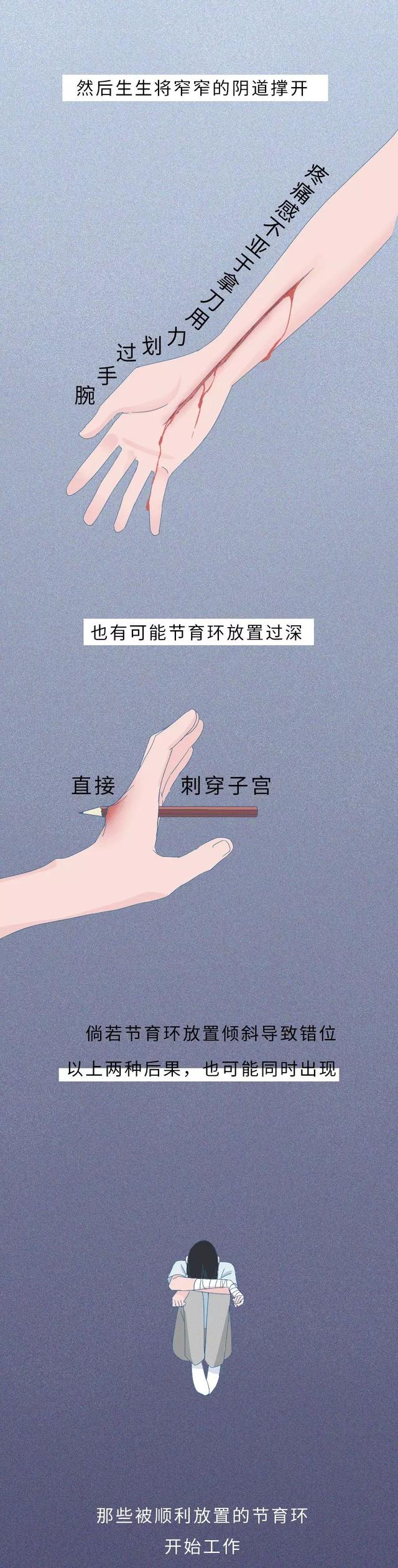 一张图告诉你“节育环”在女性体内的20年，没人能笑着看完