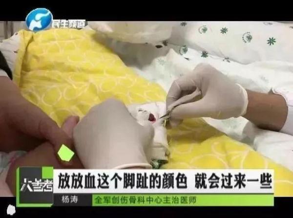 “紫砂掌”少年惊动多科室医学专家！几盆水洗黑，他居然好了
