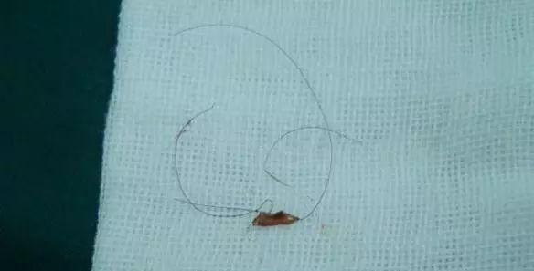 “紫砂掌”少年惊动多科室医学专家！几盆水洗黑，他居然好了