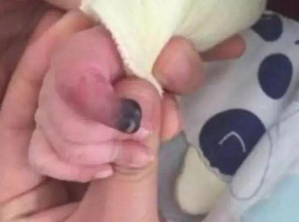 “紫砂掌”少年惊动多科室医学专家！几盆水洗黑，他居然好了