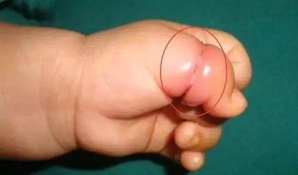 “紫砂掌”少年惊动多科室医学专家！几盆水洗黑，他居然好了