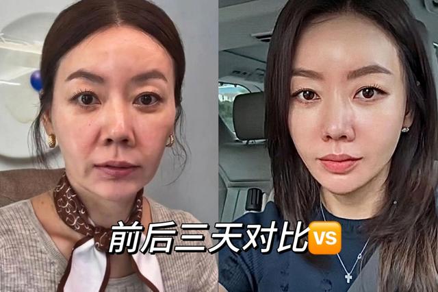 45岁,在脸上花了整整20万,跟大家分享一下我的真实感受和教训。