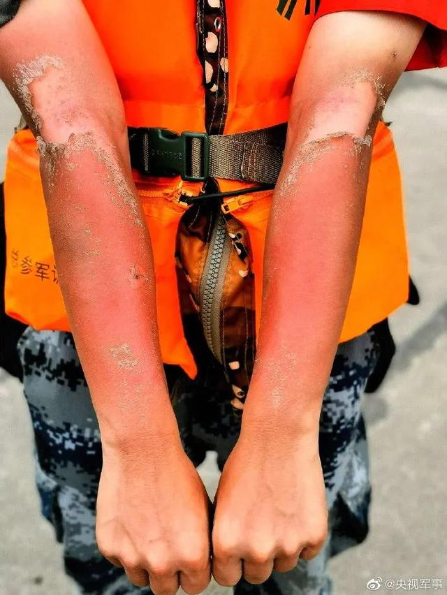 他们的“勋章”让人太心疼！幸好“应援团”来了