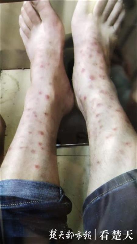 小跳蚤成大问题,写字楼上班族多方求助