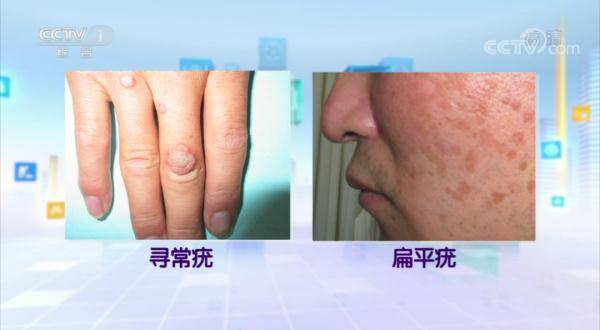 身上长的“小肉揪揪”预示感染了HPV病毒？专家解答来了