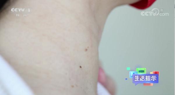 身上长的“小肉揪揪”预示感染了HPV病毒？专家解答来了