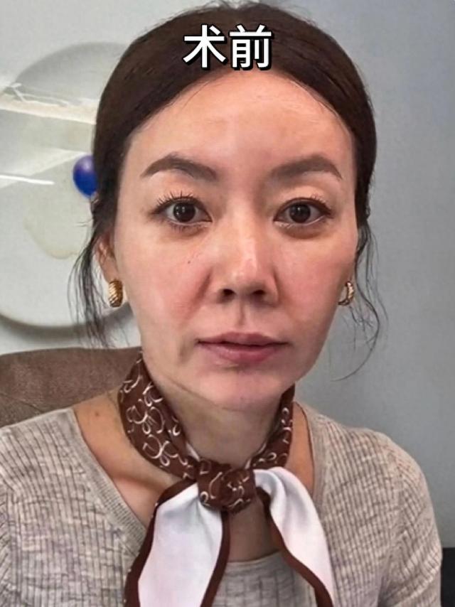 45岁,在脸上花了整整20万,跟大家分享一下我的真实感受和教训。