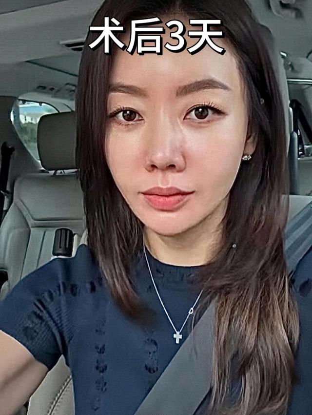 45岁,在脸上花了整整20万,跟大家分享一下我的真实感受和教训。