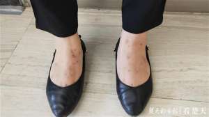 黑肖(小跳蚤成大问题，写字楼上班族多方求助)