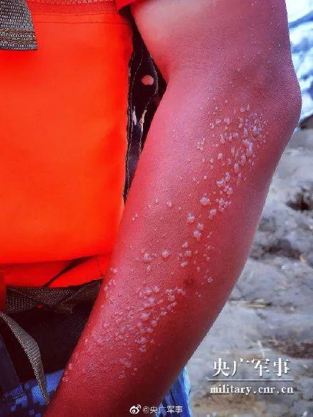 他们的“勋章”让人太心疼！幸好“应援团”来了