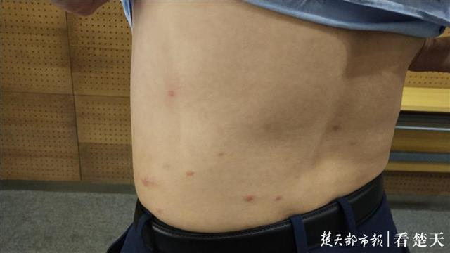 小跳蚤成大问题,写字楼上班族多方求助