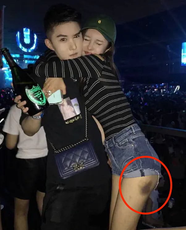 遭王思聪殴打的女孩武迪发声，见义勇为惹其不满，受伤处淤青明显