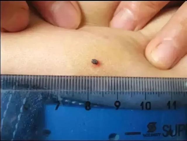 2岁娃眼皮上突然冒出一个小黑点！医生：这东西会要命！