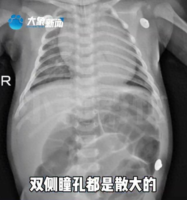 52天宝宝中毒进ICU！因奶奶喂水加了这种极常见食品！其中风险必须了解→