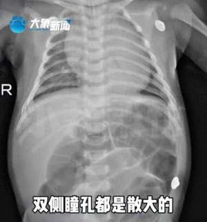 哄逗(52天宝宝中毒进ICU因奶奶喂水加了这种极常见食品其中风险必须了解→)