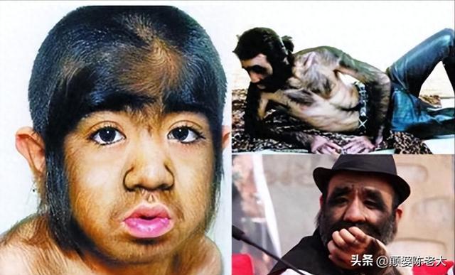 当年轰动一时的“毛孩”：42岁娶90后娇妻，生下一子未遗传长毛