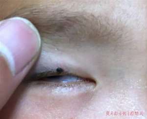 一个缘下面两个虫(2岁娃眼皮上突然冒出一个小黑点医生：这东西会要命)
