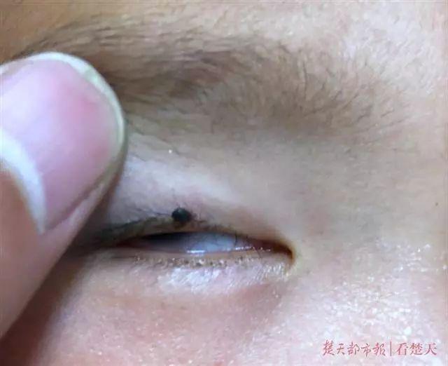 2岁娃眼皮上突然冒出一个小黑点！医生：这东西会要命！
