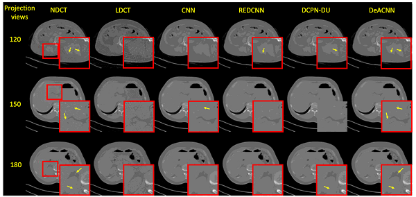 低剂量CT成像研究取得新进展