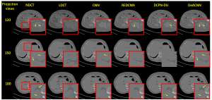 胡战利(低剂量CT成像研究取得新进展)