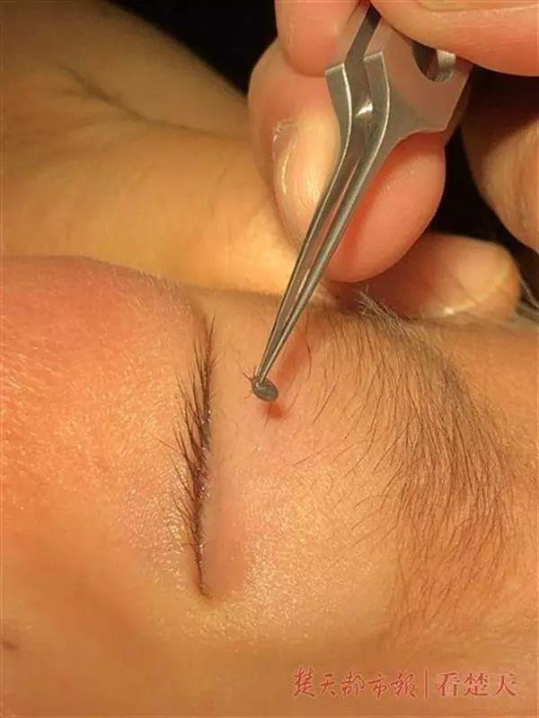 2岁娃眼皮上突然冒出一个小黑点！医生：这东西会要命！