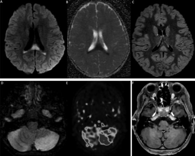 台湾地区多名儿童感染新冠后出现脑炎，是感染后的新症状吗？