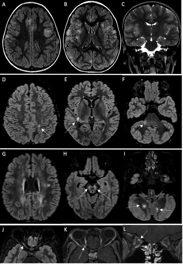 台湾地区多名儿童感染新冠后出现脑炎，是感染后的新症状吗？