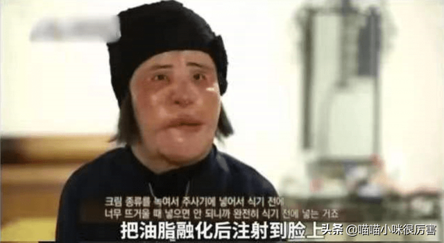 女星韩慧景：整容上瘾，往脸上注入7斤色拉油，面目全非太可惜