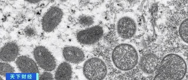 超1.6万例！美国一男子同时感染猴痘和新冠！“双倍痛苦，几乎不能下床”