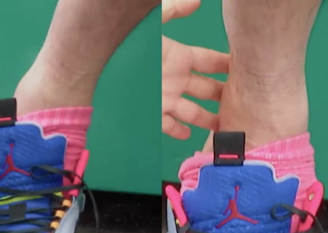 35岁陈赫手术后顺利出院！单腿蹦跳显滑稽，胡子拉碴脸消瘦不少