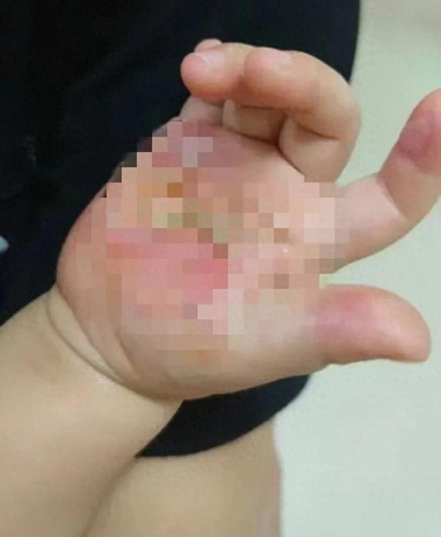 痛！摸了一下，手掌皮肤像“被融了”！最近高发，务必警惕！
