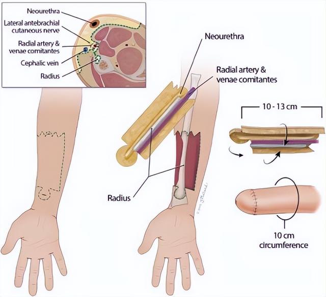 英国双性人网红兼有卵巢和睾丸，花60万再造丁丁，又用卵子生了娃
