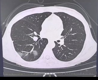 紧急提醒！杭州女子查出流感后硬抗3天，肺都“白”了！这种情况赶紧就医