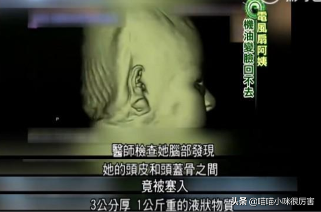 女星韩慧景：整容上瘾，往脸上注入7斤色拉油，面目全非太可惜