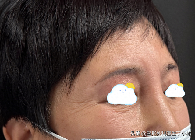 50岁女士13年间反复做鼻部整形，把鼻子整成“通天鼻”来取出异物