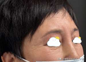 整容鼻子(50岁女士13年间反复做鼻部整形，把鼻子整成“通天鼻”来取出异物)