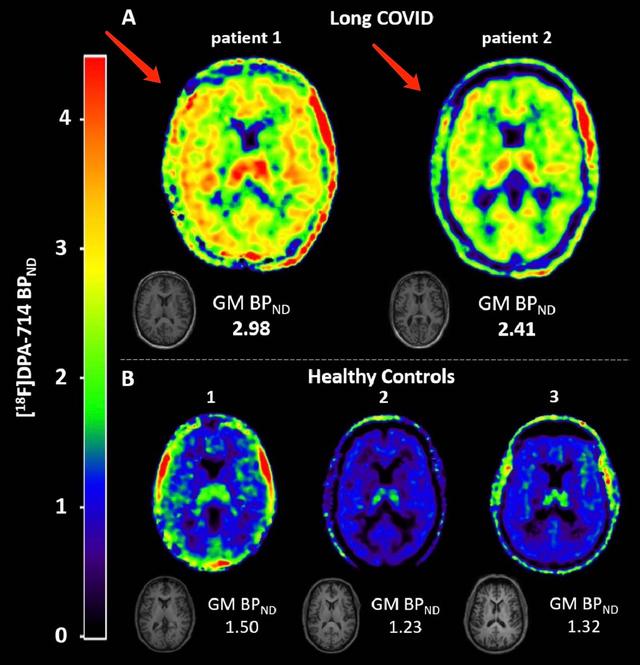 台湾地区多名儿童感染新冠后出现脑炎，是感染后的新症状吗？
