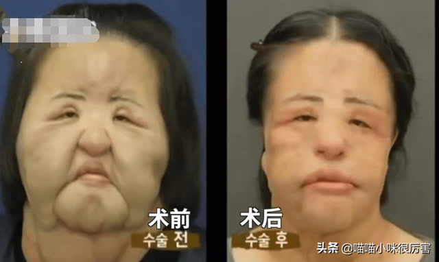 女星韩慧景：整容上瘾，往脸上注入7斤色拉油，面目全非太可惜