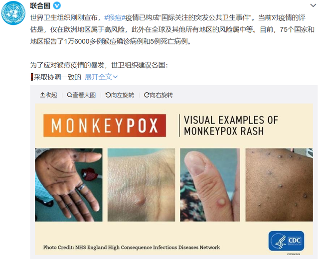 超1.6万例！美国一男子同时感染猴痘和新冠！“双倍痛苦，几乎不能下床”